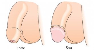 Cắt bao quy đầu ở đâu tốt, an toàn, uy tín tại Hà Nội? Top 7 địa chỉ đáng xem