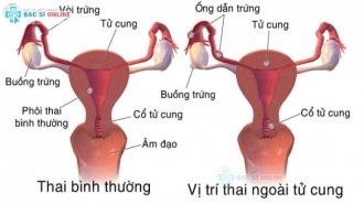 Dấu hiệu mang thai ngoài tử cung như thế nào?