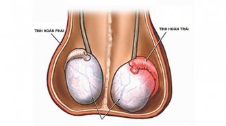 Nguyên nhân đau tinh hoàn trái và cách chữa trị hiệu quả
