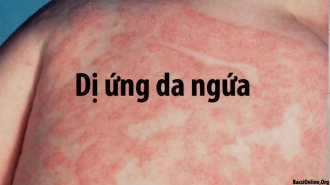 Bị dị ứng da ngứa dữ dội là bệnh gì? Có chữa được không