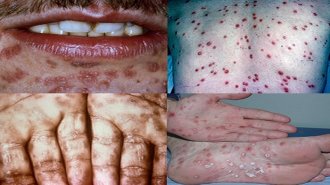 Thông tin cần biết về bệnh giang mai: Nguyên nhân, triệu chứng và chẩn đoán và điều trị bệnh giang mai