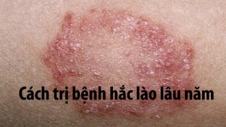 Bệnh hắc lào lâu năm có chữa khỏi được không?