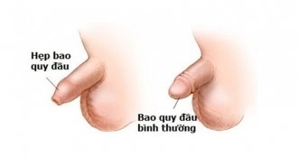 Hẹp bao quy đầu ở trẻ 2 tuổi chữa thế nào?