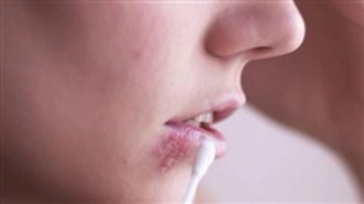 Bệnh herpes sinh dục là gì? Hình ảnh nhận biết và cách điều trị