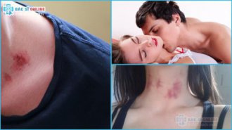 Hickey là gì? cách hôn hickey táo bạo mà an toàn