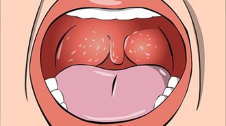 Dấu hiệu bệnh lậu ở miệng, họng