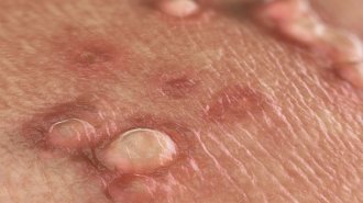 Mụn cóc sinh dục là gì? Có nguy hiểm không