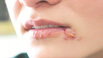 Mụn rộp sinh dục là gì? Triệu chứng và cách phòng bệnh