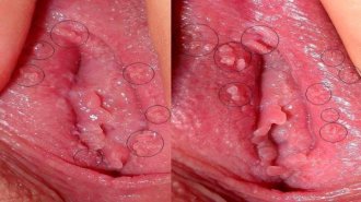   Nổi mụn thịt ở vùng kín nữ giới là biểu hiện bệnh gì?
