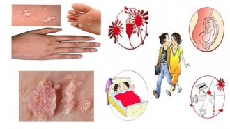Nguyên nhân gây ra bệnh sùi mào gà ở nam giới và nữ giới