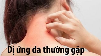 Những loại dị ứng da thường gặp và cách chữa hiệu quả