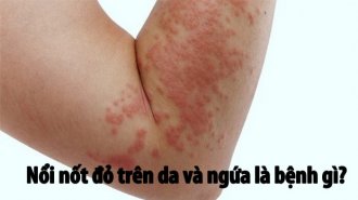 Nổi nốt đỏ trên da và ngứa là dấu hiệu của bệnh gì