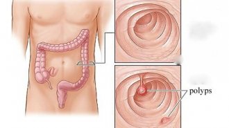 Bệnh polyp hậu môn là gì? Triệu chứng, cách chữa bệnh polyp hậu môn