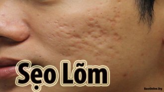 Nguyên nhân gây sẹo lõm là gì? Bị sẹo lõm thì phải làm sao? 