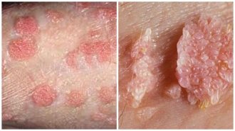 Bệnh sùi mào gà có gây ngứa không? Phải làm sao khi bị sùi mào gà