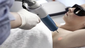 Điều trị hôi nách bằng laser hết bao nhiêu tiền?