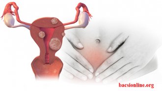 7 triệu chứng của bệnh u xơ cổ tử cung điển hình nhất