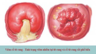 Viêm cổ tử cung là gì? Nguyên nhân & triệu chứng