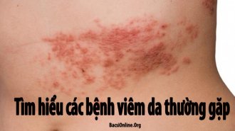 Nhận biết các loại bệnh viêm da thường gặp và cách trị hiệu quả 