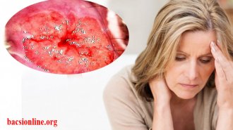 Viêm lộ tuyến cổ tử cung là gì? Triệu chứng của viêm lộ tuyến độ 1,2,3