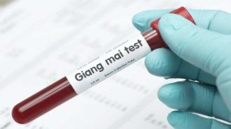 VDRL là gì? Phương pháp xét nghiệm VDRL dùng để kiểm tra gì?