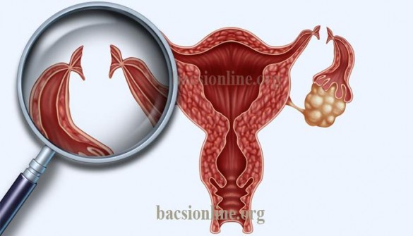 Thắt ống dẫn trứng như thế nào? Chi phí bao nhiêu tiền?