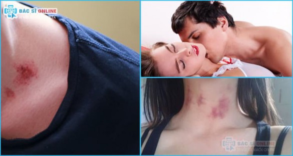 Hickey là gì? cách hôn hickey táo bạo mà an toàn