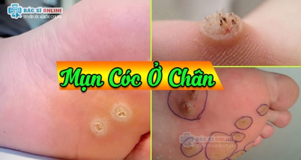 Mụn cóc ở chân có nguy hiểm không, nguyên nhân, triệu chứng, cách chữa