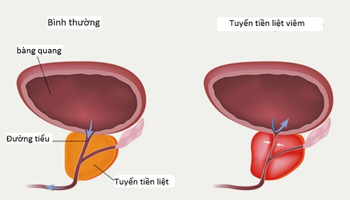 Viêm tuyến tiền liệt là gì? Viêm tuyến tiền liệt nguy hiểm không?